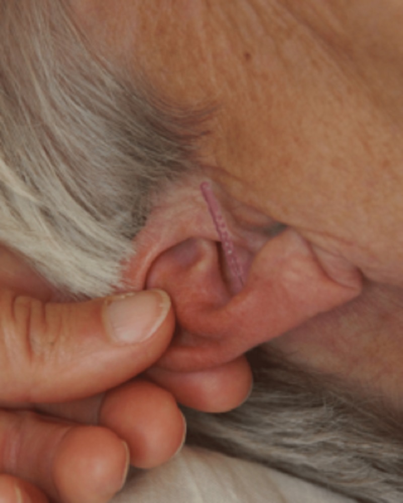 Behandling med auriculoterapi, også kaldet øreakupunktur