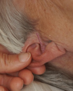 Der behandles også med auriculoterapi (øreakupunktur) i klinikken